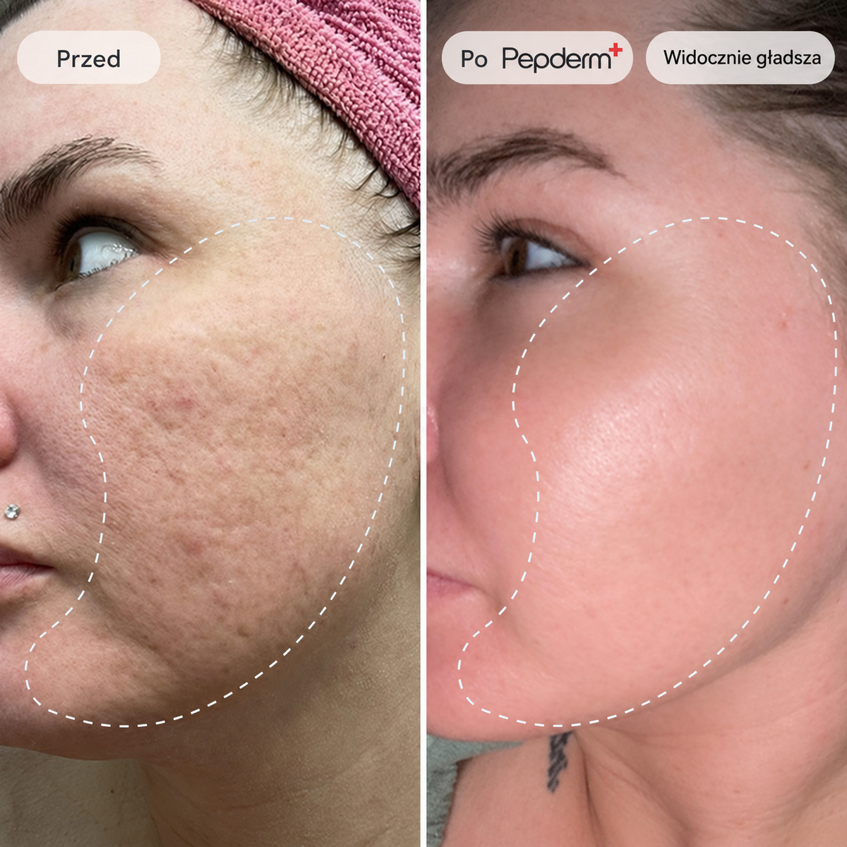 Pepderm™ | Mikroinfuzja ANTI-AGING