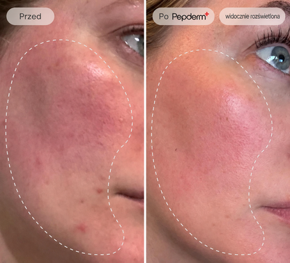 Pepderm™ | Mikroinfuzja ANTI-AGING