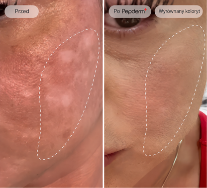Pepderm™ | Mikroinfuzja ANTI-AGING