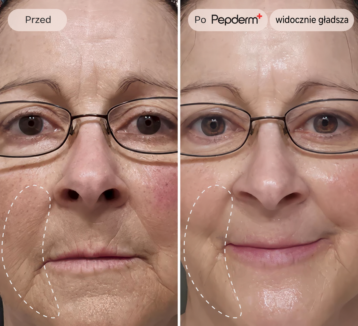 Pepderm™ | Mikroinfuzja ANTI-AGING