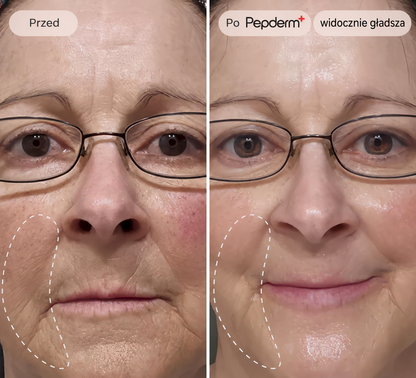 Pepderm™ | Mikroinfuzja ANTI-AGING
